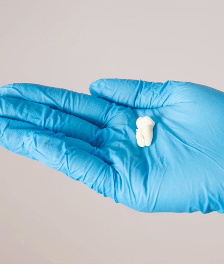 A imagem mostra uma mão vestida com uma luva cirúrgica azul segurando uma pequena quantidade de material dental(dente siso), A composição é simples, com o produto colocado no centro da palma da mão, e o fundo neutro ajuda a destacar o objeto (dente). A luva azul indica práticas de higiene e a natureza profissional do cenário.