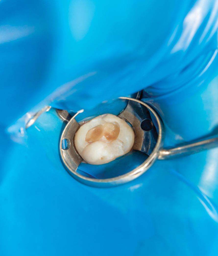 Imagem de um dente sendo isolado com técnicas odontológicas para realizar o procedimento de restauração dentárias