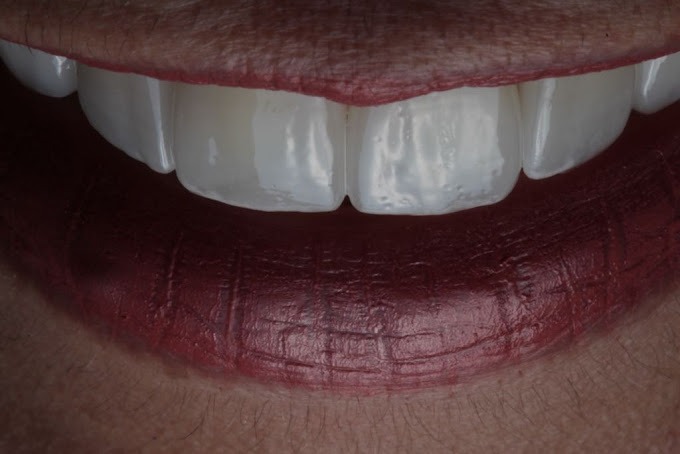 facetas de porcelana